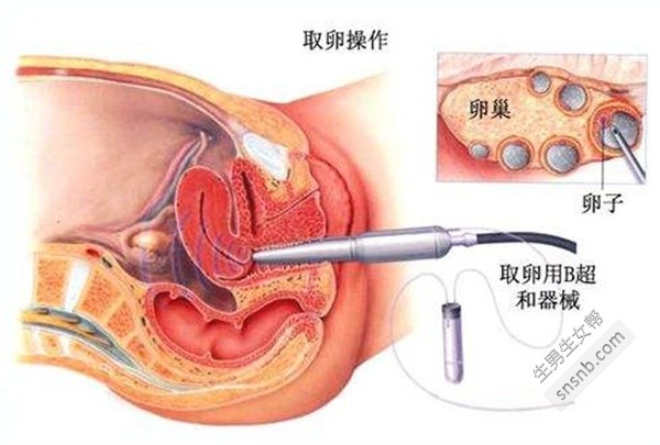 试管取卵条件的全面解析