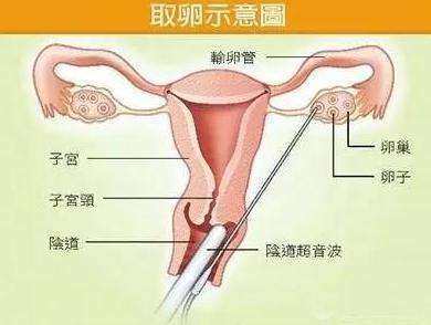 关于取卵痛不痛，深入了解与关怀