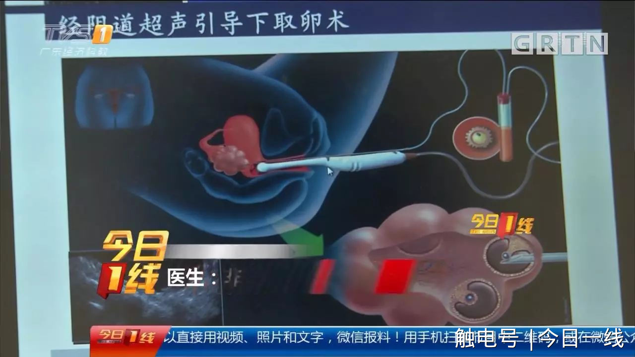 取卵全麻省妇保，现代生殖医学的细致关怀与安全保障